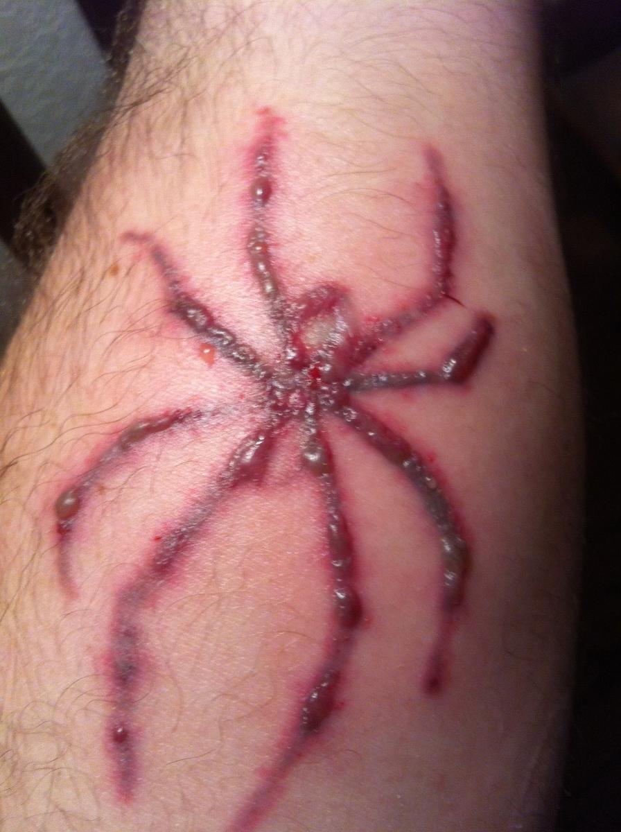 Laser tattoo removal 5